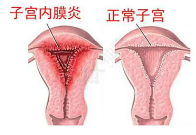 全自动阴道分泌物JK漫画在线观看厂家子宫内膜炎的症状表现提前了解与预防