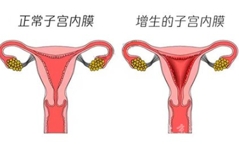白带常规JK漫画在线观看厂家解读子宫内膜增生是什么原因引起的